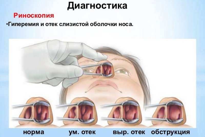 Риноскопия