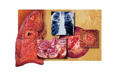 Палочки коха