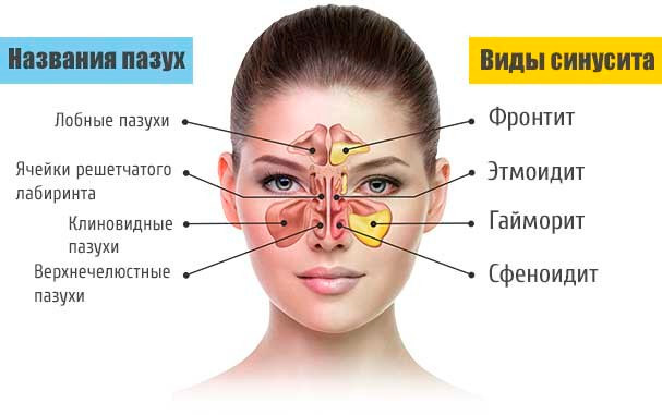 Виды синусита