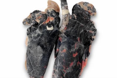 Легкие курильщика