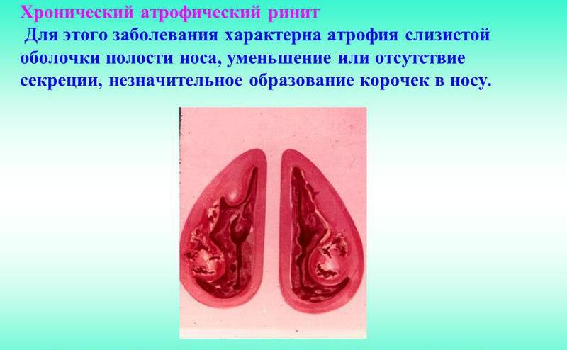 Атрофический ринит