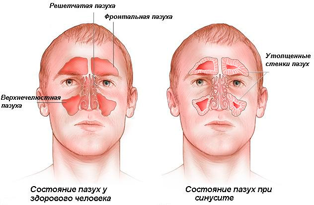 Синусит