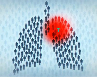 пути передачи туберкулеза