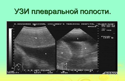 Результаты узи