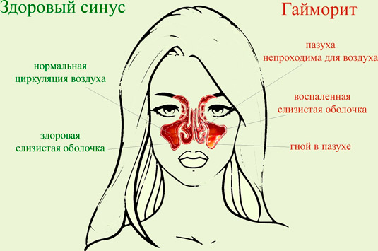 Гайморит