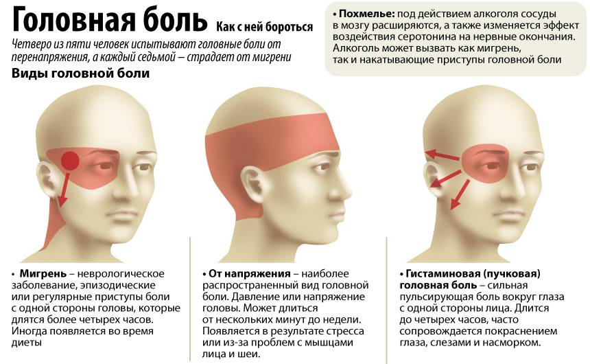 Цефалгия