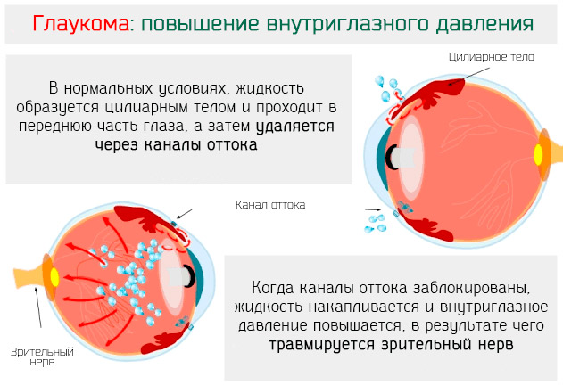 Глаукома