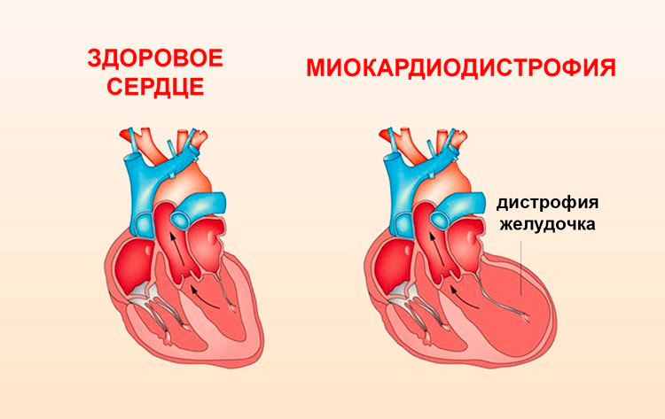 Дистрофия миокарда