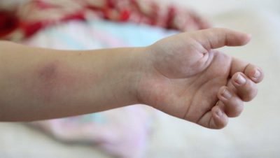 дети с положительной пробой Манту