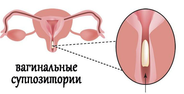 свечи от цистита у женщин быстрое лечение