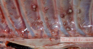 Что такое туберкулез в 21 веке, органы мишени и расшифровка диагноза с МБТ и МЛУ