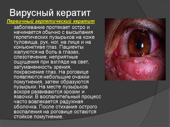 Вирусный кератит