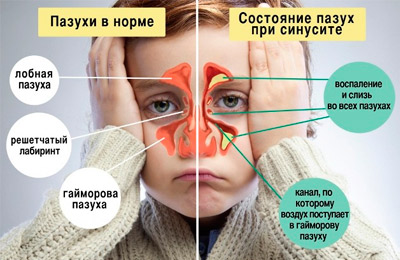 Гнойный синусит