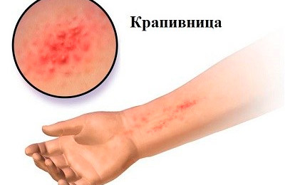 Крапивница