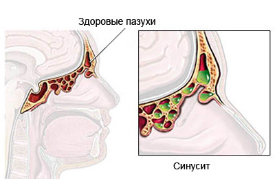 Синусит