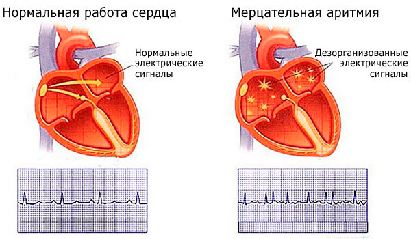 Аритмия