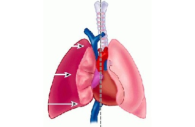 Пневмоторакс