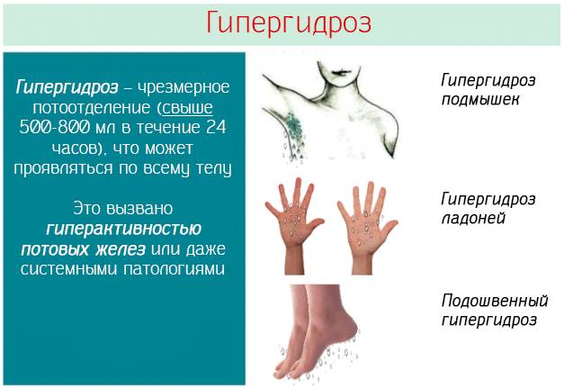 Гипергидроз