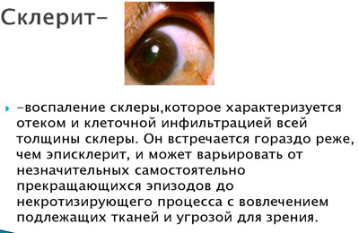 Склерит