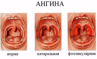 Ангина