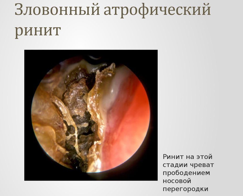 Атрофический ринит