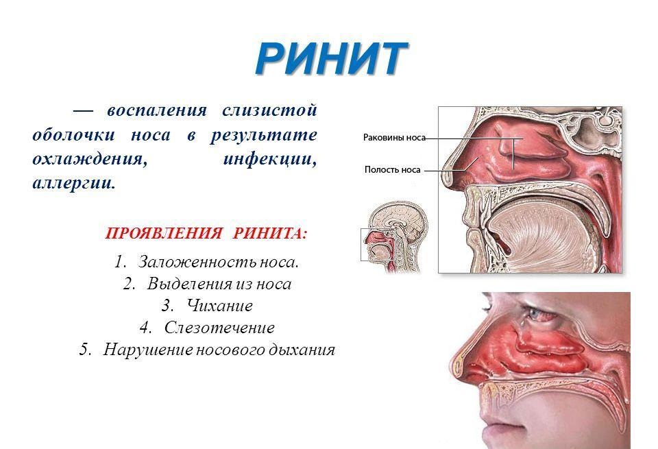Симптомы ринита