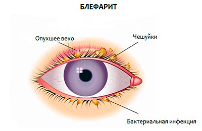 Блефарит