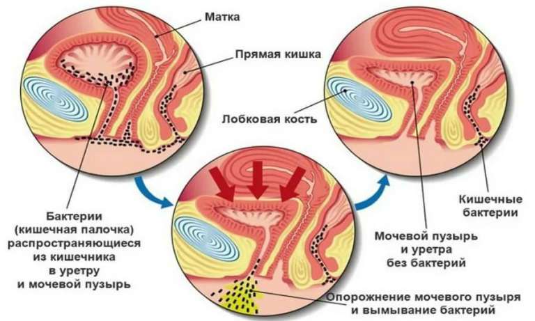 история болезни цистит в стадии обострения
