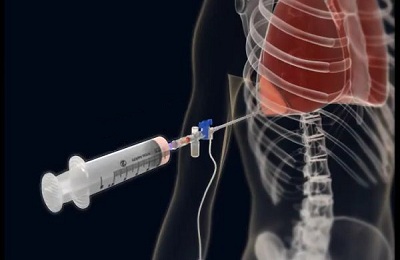 Проведение процедуры