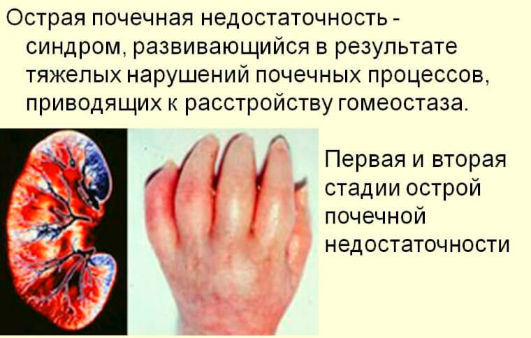 Почечная недостаточность