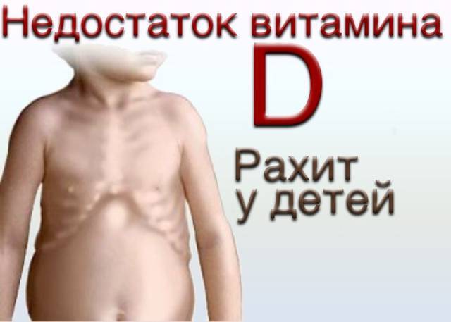 Рахит у детей симптомы и лечение